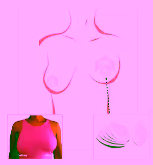 Invisible Cleavage Enhancing Push up Bra - Deluxe Set